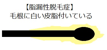 全種類の脱毛症状一覧 薄毛や脱毛症の種類は 毛根を見て分かる見分け方も解説 ゼウス発毛 名古屋の格安発毛サロン 500円で育毛