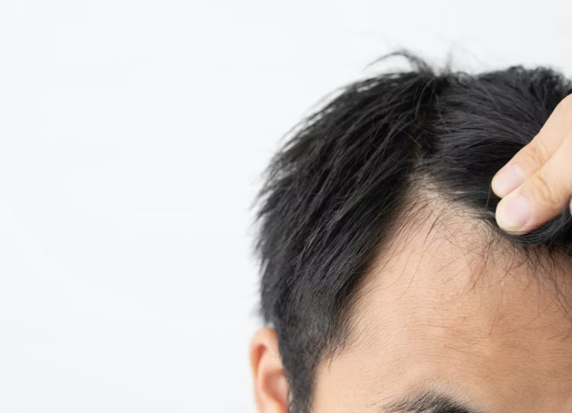 脂漏性脱毛症の症状とは？