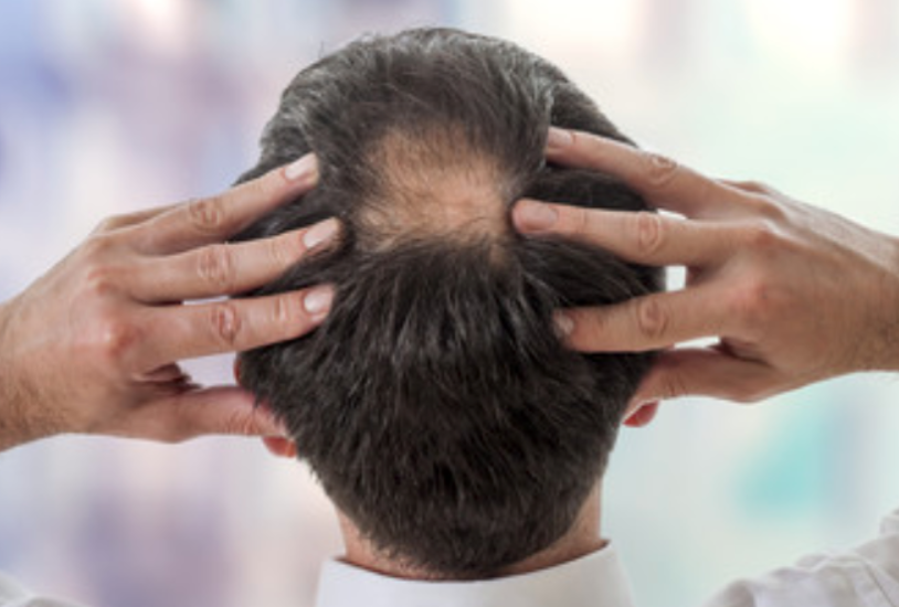 発毛を阻害する5つの活性酸素とは？