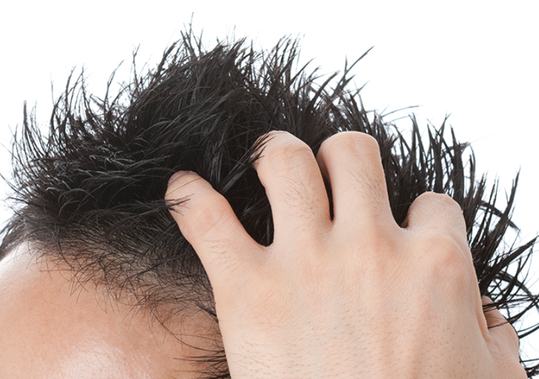 手遅れの状態になる前に！発毛を諦める前に考えるべきポイントとは？