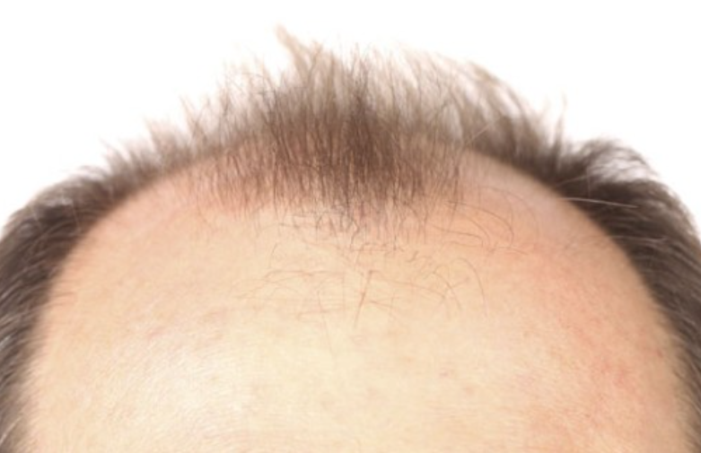 さいごに｜発毛には頭皮環境が大切！不飽和脂肪酸でメンテナンス！