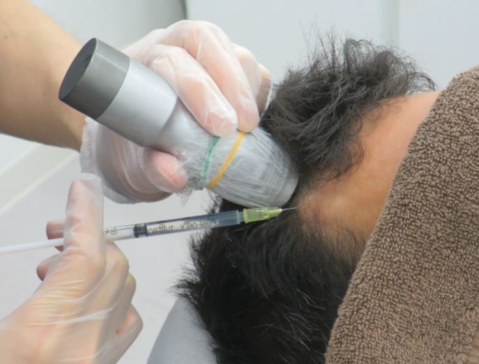 HARG療法の流れを解説！より発毛効果を得るためにできることとは？